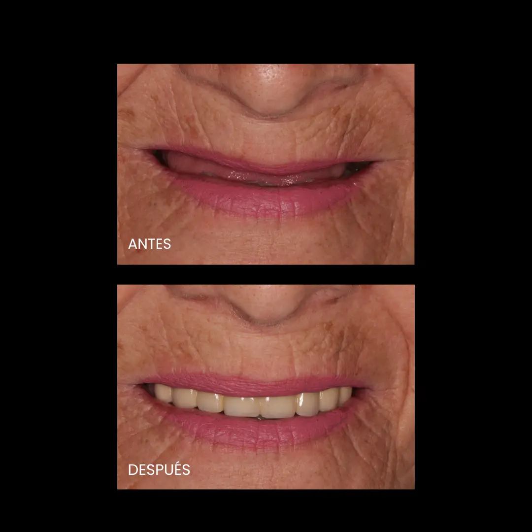 Dr. Francisco Ortiz, Cirujano Dentista e Implantólogo especializado en tratamientos avanzados de implantología y rehabilitación oral. Experiencia, precisión y cuidado en cada sonrisa.