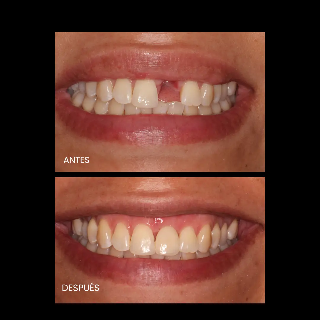 Dr. Francisco Ortiz, Cirujano Dentista e Implantólogo especializado en tratamientos avanzados de implantología y rehabilitación oral. Experiencia, precisión y cuidado en cada sonrisa.
